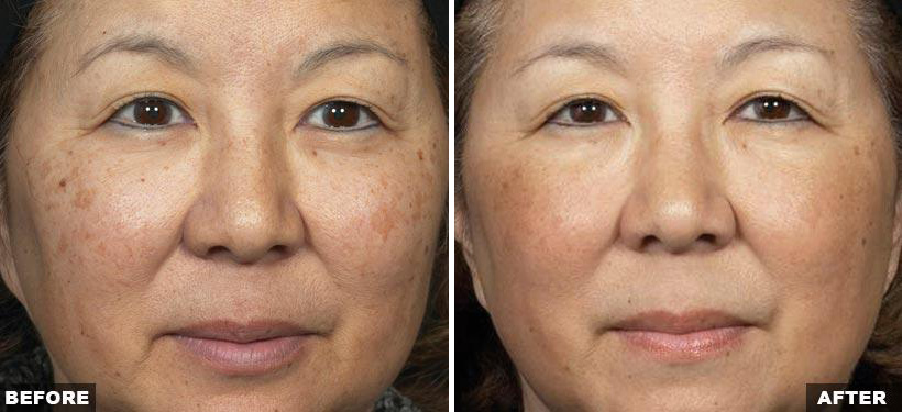 Fractional Laser Resurfacing Near Me Jackson Oneill