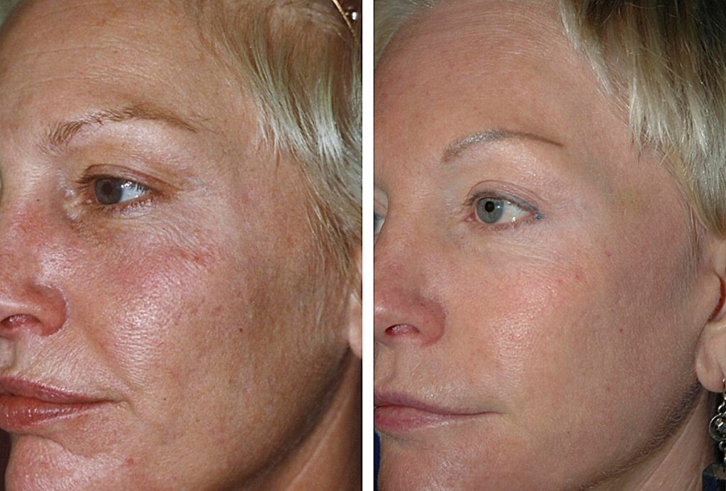 Fractional Skin Resurfacing Laub Dermatology