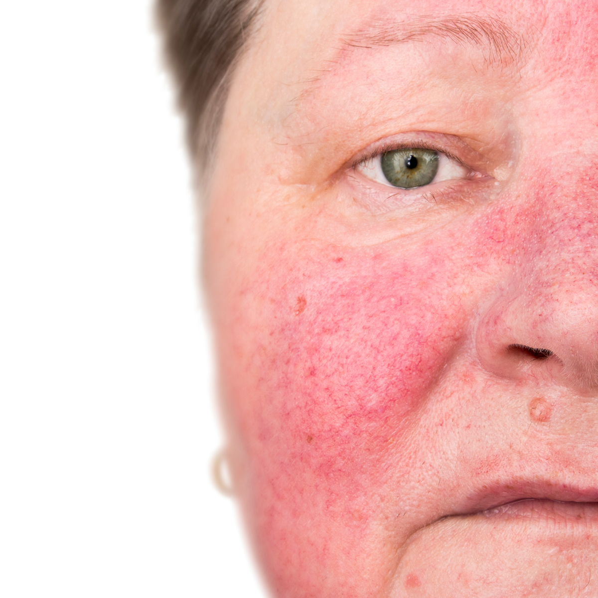 Is Rosacea Acne?