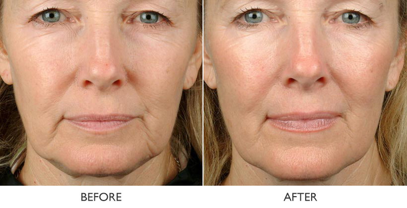 Thermage Noninvasive Skin Tightening